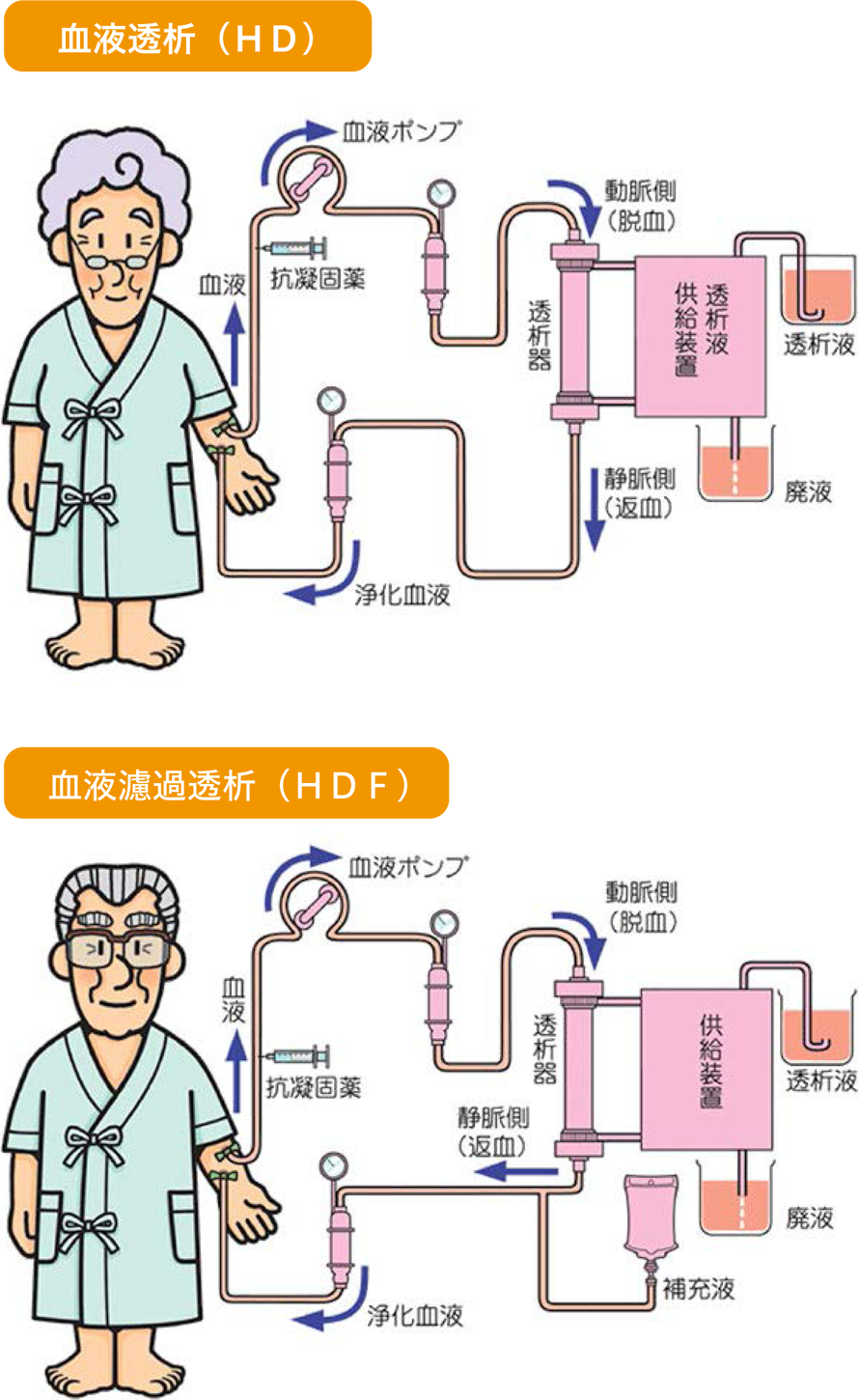 血液透析（HD） 血液濾過透析（HDF）